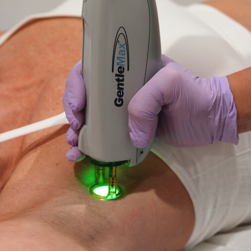 Laser Hair Removal New Fairfield CT Liv Aesthetics