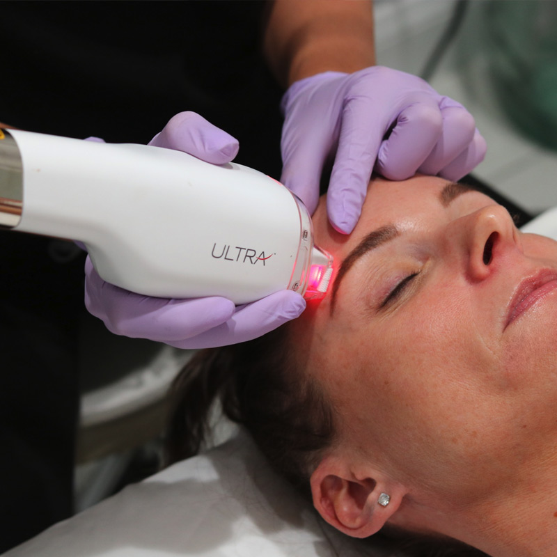 Laser Skin Resurfacing New Fairfield CT Liv Aesthetics